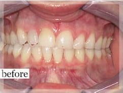 Before Image: Smile Makeover - front