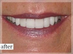 After Image: Smile Makeover - front