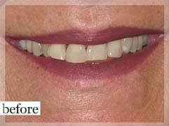 Before Image: Smile Makeover - front