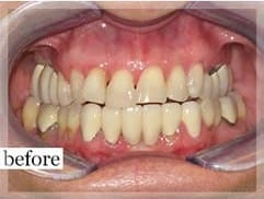 Before Image: Smile Makeover -