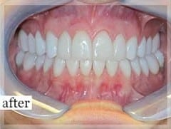 After Image: Smile Makeover - front