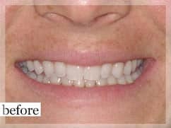 Before Image: Smile Makeover - front