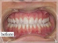 Before Image: Smile Makeover - front