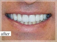 After Image: Smile Makeover - front