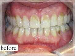 Before Image: Smile Makeover - front