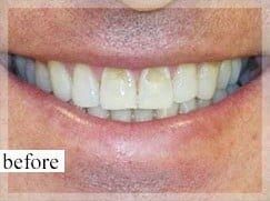 Before Image: Smile Makeover - front