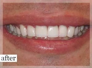 After Image: Smile Makeover - front