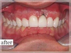 After Image: Smile Makeover - front