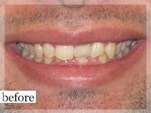 Before Image: Smile Makeover - front