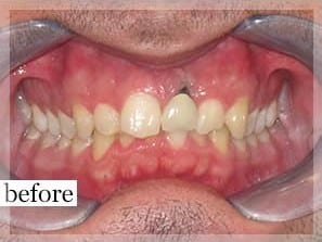 Before Image: Smile Makeover - front