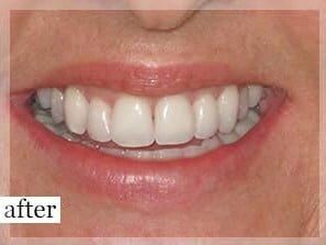 After Image: Smile Makeover - front