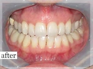 After Image: Smile Makeover - front