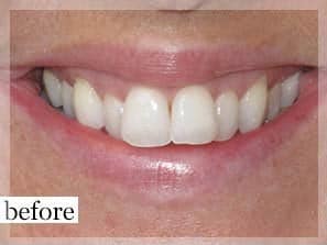 Before Image: Smile Makeover - front