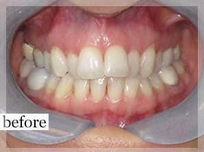 Before Image: Smile Makeover - front