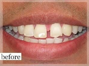 Before Image: Smile Makeover - front