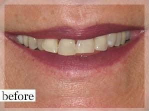 Before Image: Smile Makeover - front