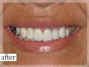 After Image: Smile Makeover - front