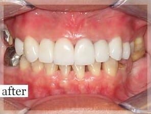 After Image: Smile Makeover - front