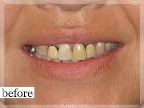 Before Image: Smile Makeover - front