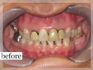 Before Image: Smile Makeover - front