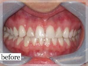 Before Image: Smile Makeover - front