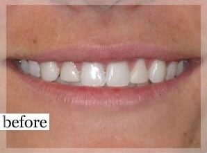 Before Image: Smile Makeover - front