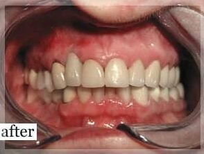 After Image: Smile Makeover - front