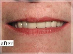 After Image: Smile Makeover - front