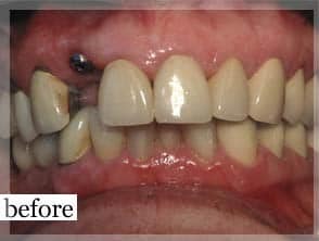 Before Image: Smile Makeover - front