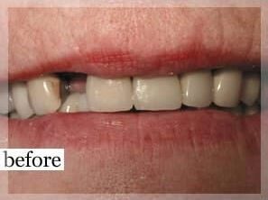 Before Image: Smile Makeover - front