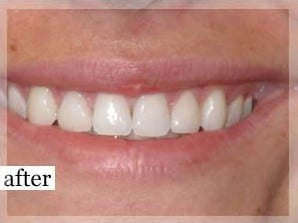 After Image: Smile Makeover - front