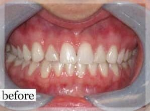 Before Image: Smile Makeover - front