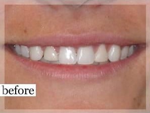 Before Image: Smile Makeover - front