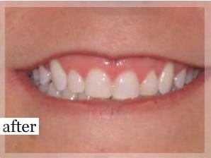 After Image: Smile Makeover - front