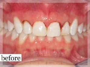 Before Image: Smile Makeover - front