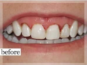 Before Image: Smile Makeover - front