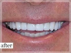 After Image: Smile Makeover - front