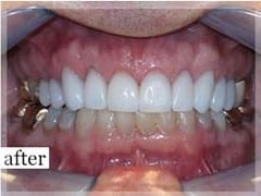 After Image: Smile Makeover - front