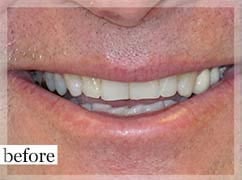 Before Image: Smile Makeover - front