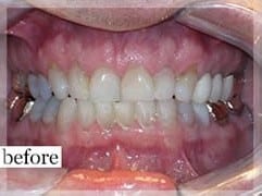 Before Image: Smile Makeover - front