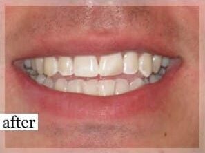 After Image: Smile Makeover - front