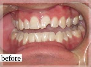 Before Image: Smile Makeover - front