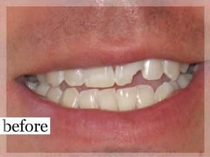 Before Image: Smile Makeover - front