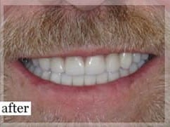 After Image: Smile Makeover - front