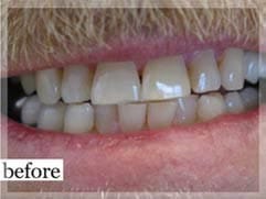 Before Image: Smile Makeover - front