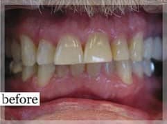 Before Image: Smile Makeover - front