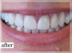 After Image: Smile Makeover - front