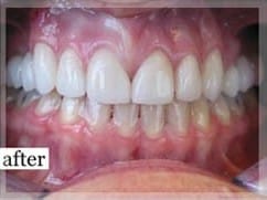 After Image: Smile Makeover - front