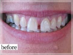 Before Image: Smile Makeover - front