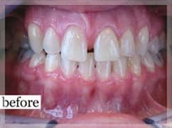 Before Image: Smile Makeover - front